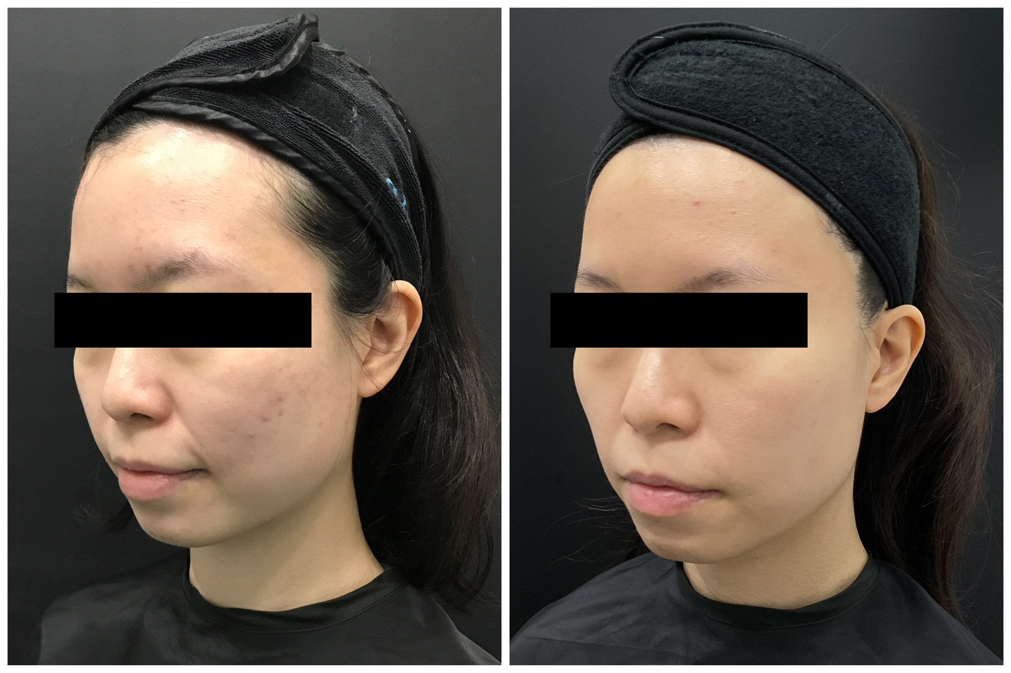 Discovery Pico Before After 2
